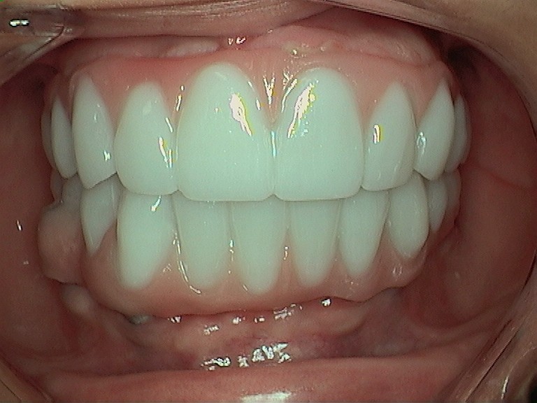 Complete Comfort Dental | Digital Impressions, VELscope® Cancer Screening and Root Canals