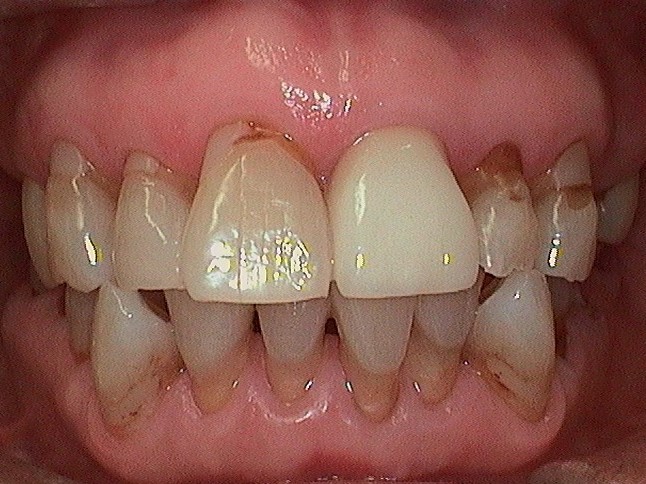 Complete Comfort Dental | Veneers, Juvederm® and All-on-4®