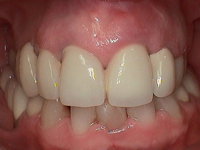 Complete Comfort Dental | ZOOM  Whitening, Sleep Apnea and Preventative Program
