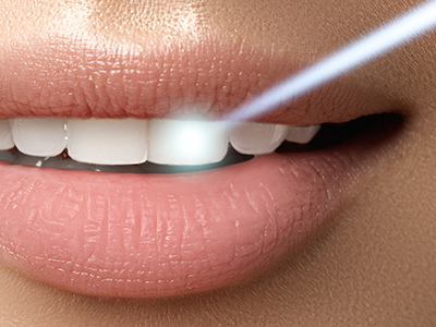 Complete Comfort Dental | Dermal Fillers, E4D and Fluoride Treatment